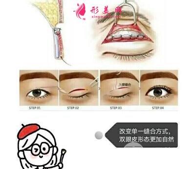 北京割雙眼皮多少錢