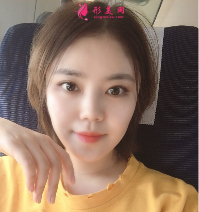 武漢韓辰整形醫(yī)院樊輝華面部吸脂