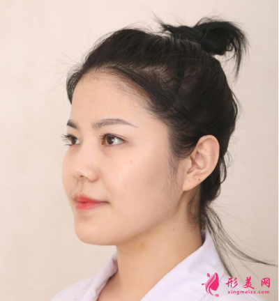 武漢韓辰整形醫(yī)院樊輝華面部吸脂