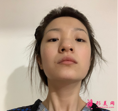 武漢韓辰整形醫(yī)院牛永敢隆鼻技術 武漢韓辰整形醫(yī)院牛永敢隆鼻技術