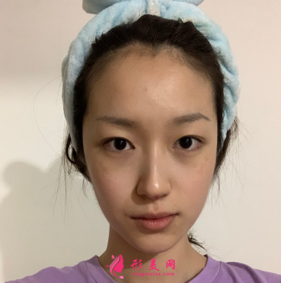 武漢韓辰整形醫(yī)院牛永敢隆鼻技術 武漢韓辰整形醫(yī)院牛永敢隆鼻技術