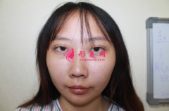 上海東方麗人整形醫(yī)院?jiǎn)毯３踝雎”鞘中g(shù)，讓您擁有精致美鼻