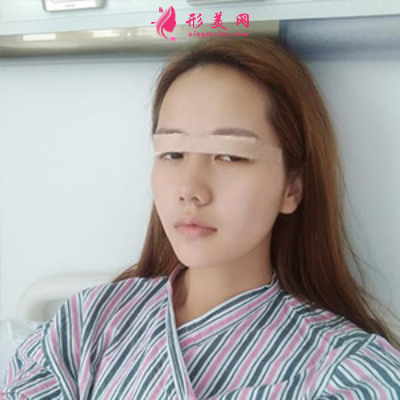 上海東方麗人整形醫(yī)院吳建明雙眼皮案例 上海東方麗人整形醫(yī)院吳建明雙眼皮案例