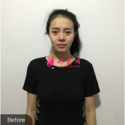 武漢卓美整形醫(yī)院做假體隆胸，術(shù)后性感美胸上線了