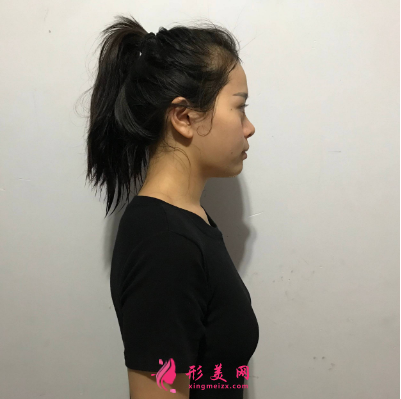 武漢一美彭義坤假體隆胸