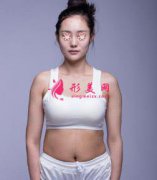 北京協(xié)和醫(yī)院整形腰腹吸脂案例，術后效果差別明顯！