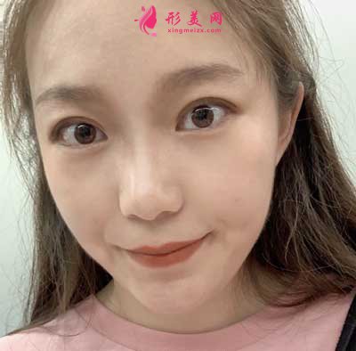 去河南整形美容醫(yī)院找聶麗麗醫(yī)生做眼綜合整形手術(shù)后1個月