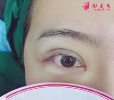 上海百達(dá)麗整形王維做雙眼皮怎么樣？60天術(shù)后效果對比真的好極了