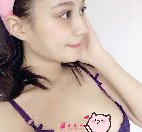 西安瑞麗郭永華醫(yī)師真人案例 隆胸90天前后對比圖分享