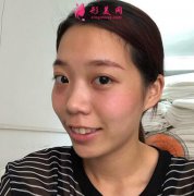 上海九院整形科可以做熱瑪吉嗎?真人案例恢復(fù)圖集一覽