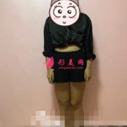 在上海第九人民醫(yī)院整形科做了大腿吸脂，輕松擺脫大象腿