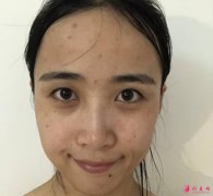 北京大學(xué)深圳醫(yī)院整形外科崔永言雙眼皮案例曝光