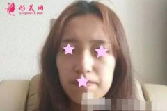 北京加減美整形怎么樣？附面部脂肪填充案例恢復(fù)效果圖