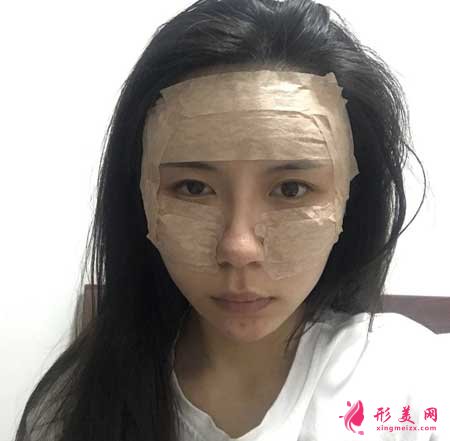 自體脂肪面部填充手術(shù)后7天