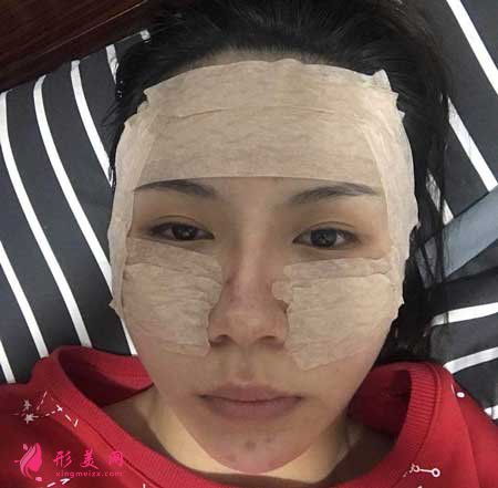 自體脂肪面部填充手術(shù)后