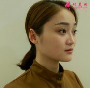 上海伯思立整形醫(yī)院隆鼻怎么樣？案例效果分享