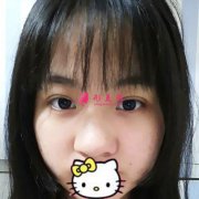 上海華美整形醫(yī)院做假體隆鼻，讓我的鼻子更加精致好看