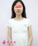 北京煤炭總醫(yī)院整形科假體隆胸后真人實拍案例 秒變C罩杯