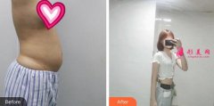 上海時(shí)光整形外科水動(dòng)力吸脂瘦肚子案例