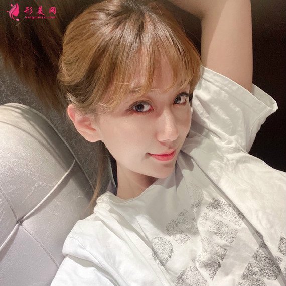 分享下我在貴陽華美做的硅膠假體隆鼻自體軟骨墊鼻尖恢復(fù)效果