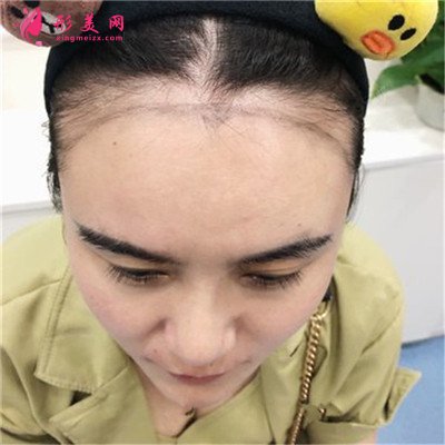 重慶華膚發(fā)際線種植手術(shù)效果反饋