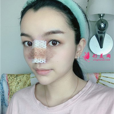 溫州膨體隆鼻術(shù)后效果分享