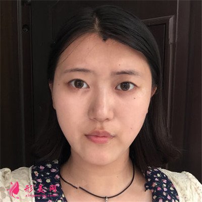 廈門切開雙眼皮手術恢復情況對比