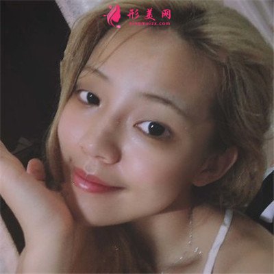 廈門(mén)小姐姐全切雙眼皮術(shù)后恢復(fù)效果分享