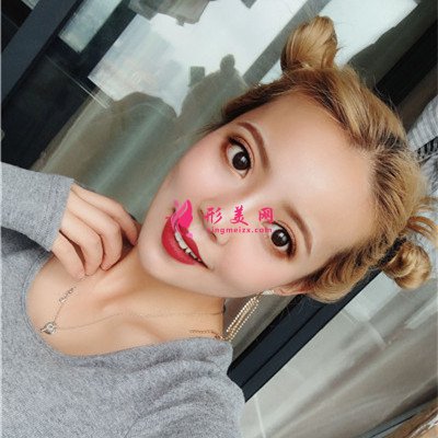 廈門(mén)小姐姐全切雙眼皮術(shù)后恢復(fù)效果分享