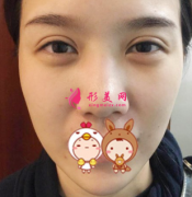 北京煤炭總醫(yī)院整形假體隆鼻60天后效果 鼻梁的弧度太美膩了