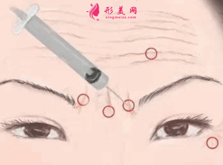 愛(ài)貝芙注射除皺前要注意什么