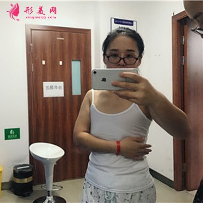 深圳漂亮小姐姐假體隆胸術(shù)后恢復(fù)情況對(duì)比