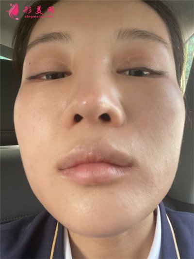 成都鼻綜合手術(shù)術(shù)后恢復(fù)情況分析