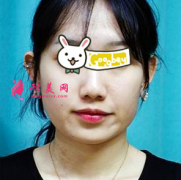 北京煤炭總醫(yī)院整形美容中心下頜角磨骨前后對比 顏值提升改善大