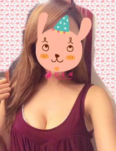 去北京麗都醫(yī)療美容醫(yī)院做自體脂肪隆胸手術(shù)后