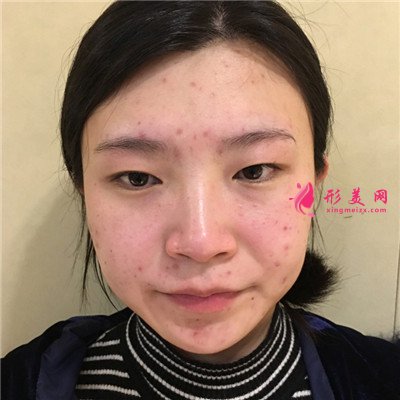 成都切開雙眼皮術(shù)后恢復(fù)情況對(duì)比