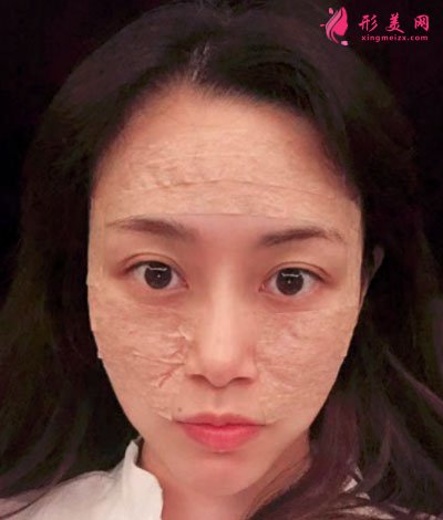 蘇州美貝爾整形美容醫(yī)院自體脂肪面部填充案例