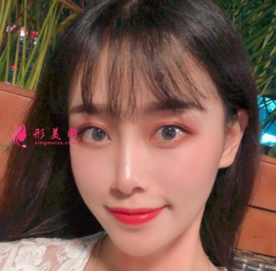 蘇州美貝爾整形美容醫(yī)院自體脂肪面部填充案例