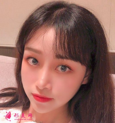 蘇州美貝爾整形美容醫(yī)院自體脂肪面部填充案例