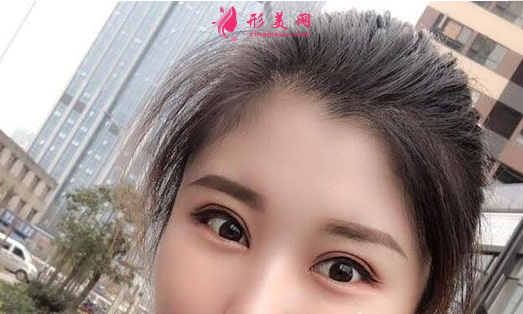 找上海美聯(lián)臣李炅默做的雙眼皮 40天術(shù)后效果恢復(fù)得簡直太好了