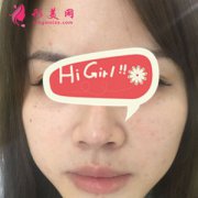 北京彤美醫(yī)療美容醫(yī)院M唇整形案例 甜美微笑唇太好看了