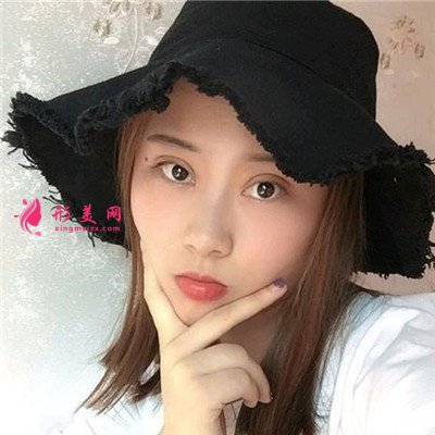 南昌小姐姐切開雙眼皮術后恢復情況對比