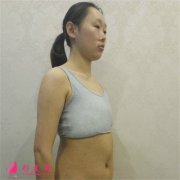 南京華美美容醫(yī)院假體隆胸手術(shù)術(shù)后恢復(fù)情況分享