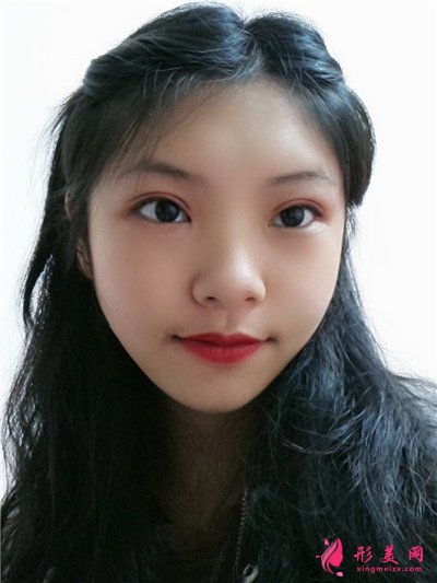 成都切開雙眼皮術(shù)后恢復情況分享 術(shù)后 成都切開雙眼皮術(shù)后恢復情況分享