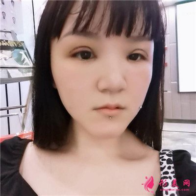 重慶切開雙眼皮術(shù)后恢復(fù)情況分享