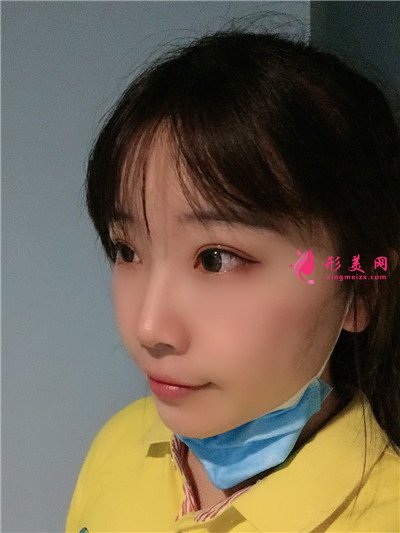 青島全切雙眼皮術(shù)后恢復(fù)情況反饋