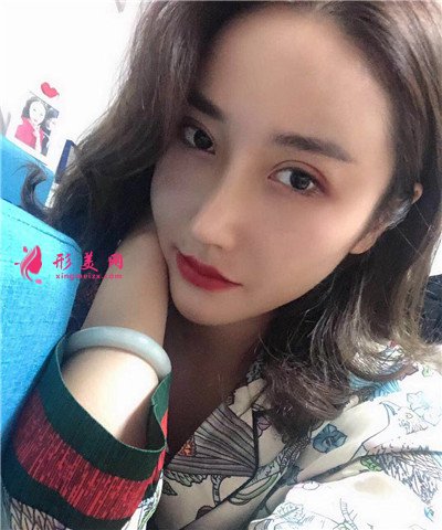 天津肋軟骨隆鼻術后恢復效果對比