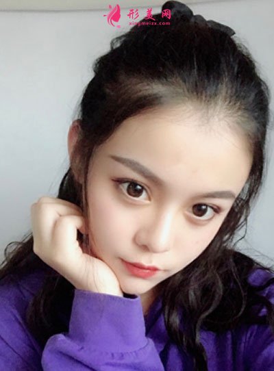 北京純脂自體做脂肪面部填充怎么樣？真實案例分