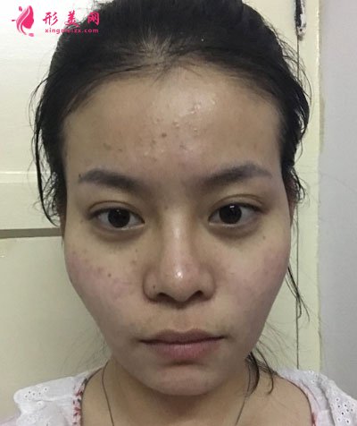 北京純脂自體做脂肪面部填充怎么樣？真實案例分