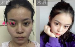 北京純脂自體做脂肪面部填充怎么樣？真實案例分